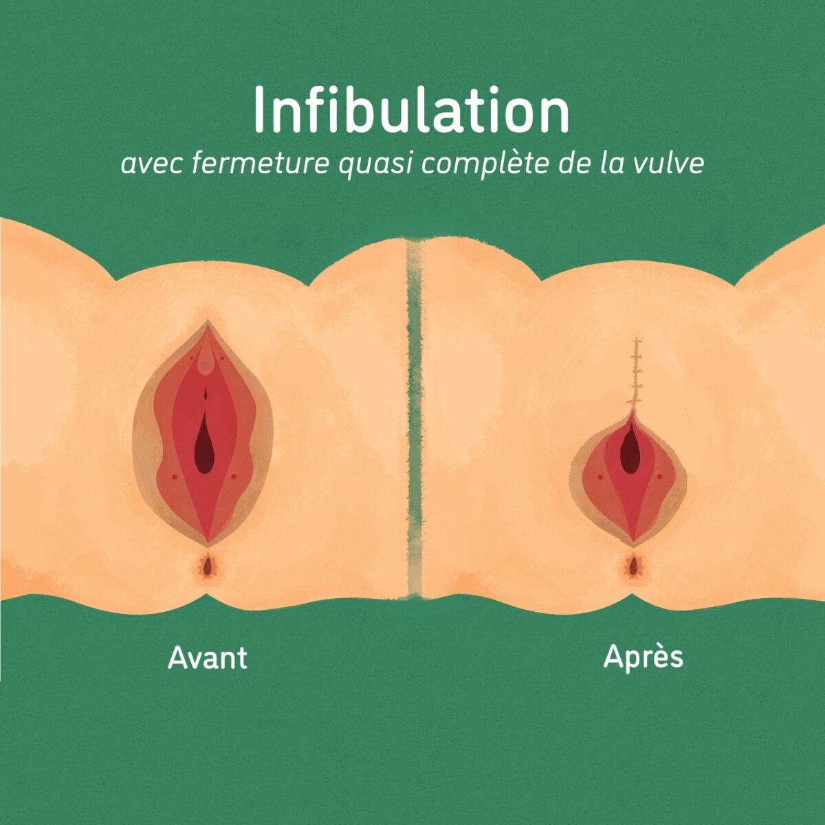 illustration excision et infibulation - mutilations génitales féminines